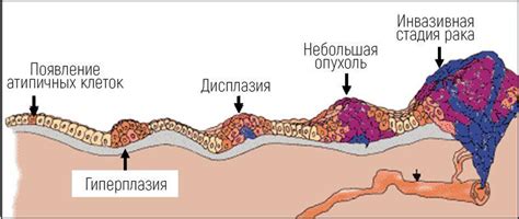 Рак шейки матки: симптомы и признаки, лечение на разных стадиях