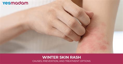 winter rash  treatment  prevention