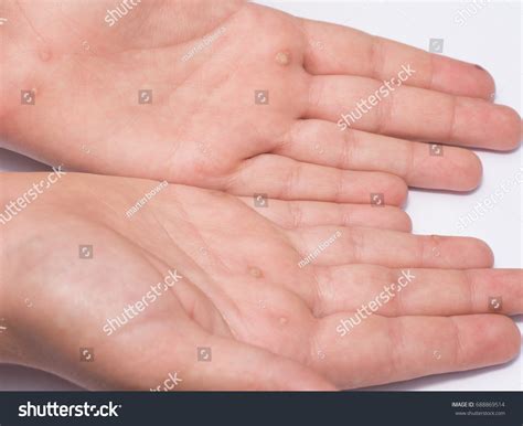 201 Types Warts Images, Stock Photos & Vectors | Shutterstock