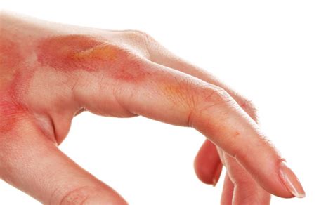 understanding  degree chemical burn treatment