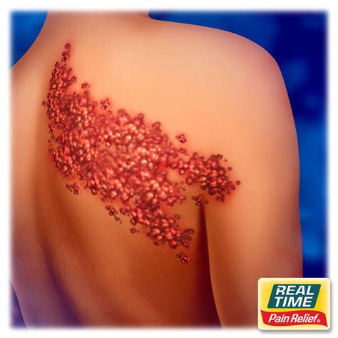 Beyond the Rash: Soothing Post-Herpetic Neuralgia After Shingles - Real