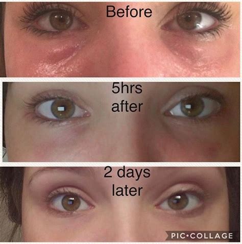 PRP Platelet Rich Plasma (Vampire Facial) Essential Beauty Medical Spa ...