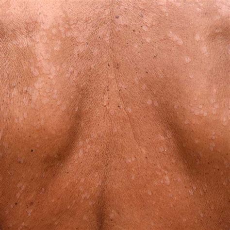 tinea versicolor pityriasis versicolor  skincare