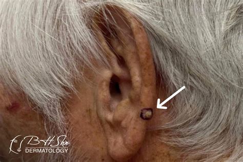 Ear Skin Cancer: A Comprehensive Guide - BHSkin Dermatology