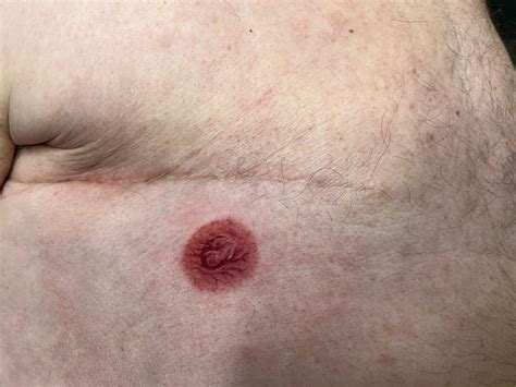 Dad gets realistic 3D nipple tattoo after breast cancer mastectomy