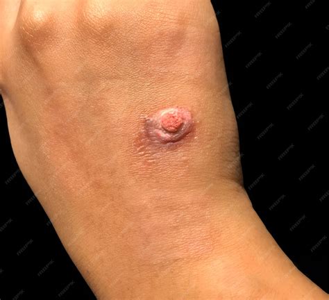 Premium Photo | Pyogenic granuloma on a hand featuring a red raised lesion