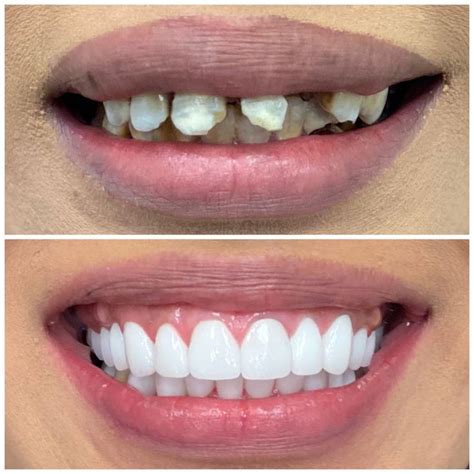 Smile Makeover Before and After