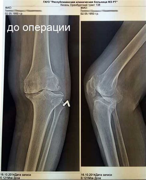 Гонартроз 1 степени коленного сустава что это такое – Гонартроз ...