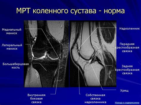 Хондромаляция надколенника степени по мрт