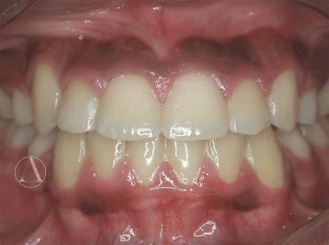 Case 2 - Consultant Orthodontist in Luton | Specialist Orthodontist in