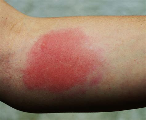 Bee And Wasp Stings
