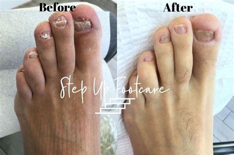 insightful stories  nail fungus medium