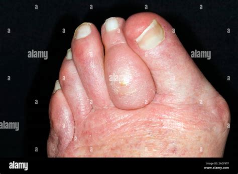 cellulitis swollen toe    year  woman caused  cellulitis