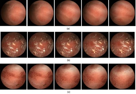 Frames showing ulcer symptoms | Download Scientific Diagram