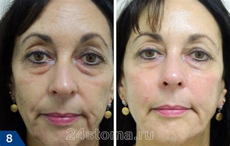 Мезонити – отзывы, фото до и после подтяжки лица, негативные последствия