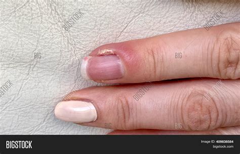 Paronychia, Swollen Finger With Fingernail Bed Inflammation, 46% OFF