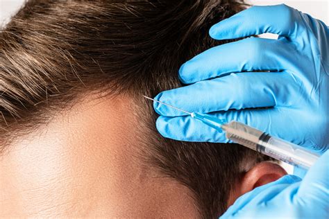 PRP Hair Treatment Newcastle: All You Need to Know