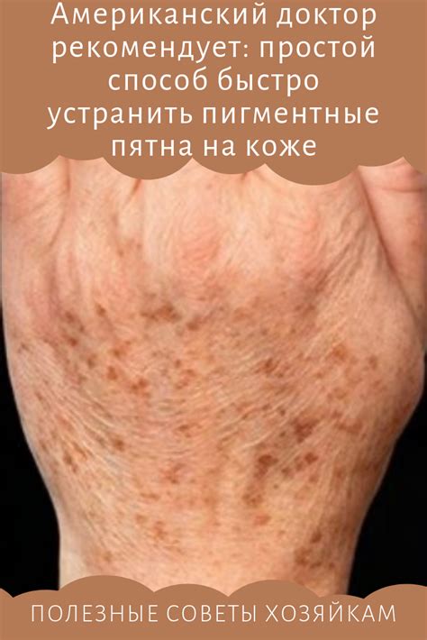 Пигментация на коже и как от нее избавиться #пигментацяи # ...