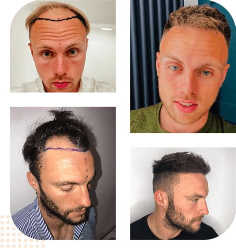 hair transplant reading berkshire award winning clinic