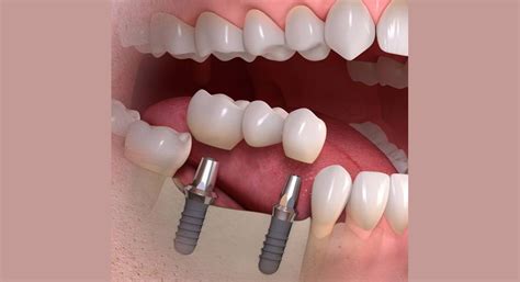 Dental Implants & Crown Placement in Thrissur| Implantology treatment ...