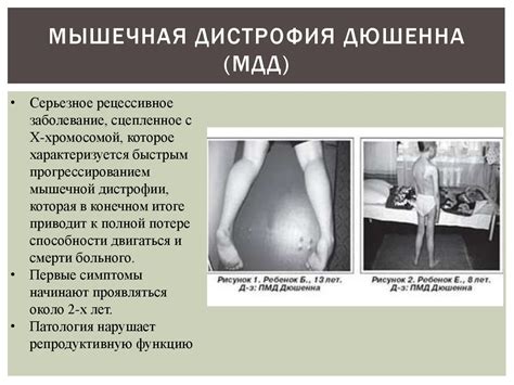 Миодистрофия Дюшенна-Беккера - презентация онлайн