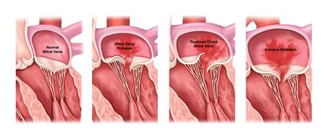 Mitral Valve Disease Background Diagnosis Treatment Options | My XXX ...