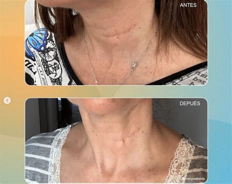 Atria Ultrassom Antes E Depois - Ultrassom Microfocado: Lifting Natural | Veja o Antes e Depois! Como ...