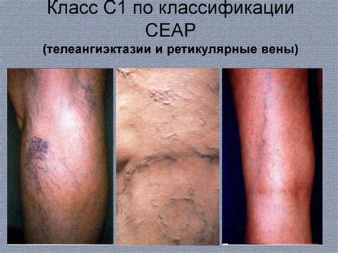 ВРВ нижних конечностей. Клиническая картина и диагностика - презентация ...