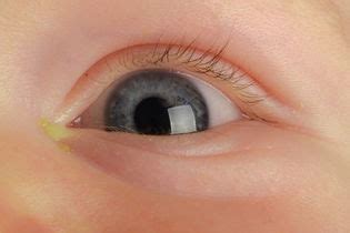 Olho Do Bebê Lacrimejando E Remelando - Olhos remelando no bebê: o que pode ser (e o que fazer) - Tua Saúde