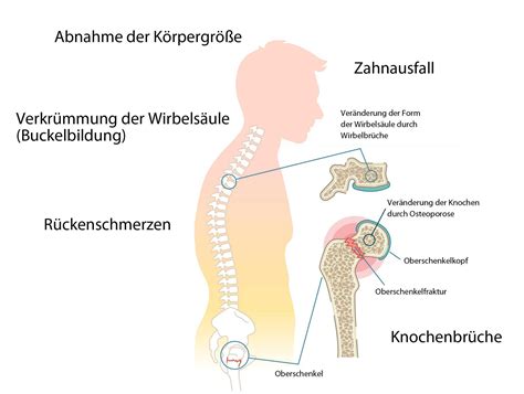 Osteoporose Vorbeugung Und Selbsthilfe Was Tun Be 7