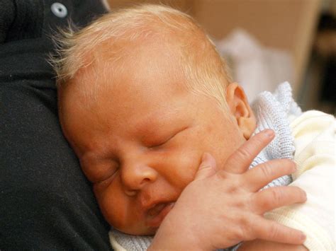 Bebe Com Icterícia Antes E Depois - Sintomas De Ictericia Do Bebe Icterícia Neonatal | Dos Sintomas Ao