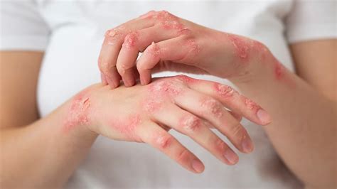 prevent tinea fungal infection  summers onlymyhealth
