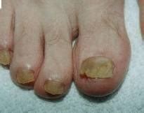 Schimmelnagel - Cleos Pedicure