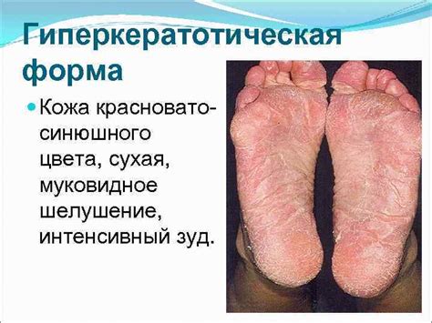 МИКОЗЫ Классификация микозов. ( по Н. Д.