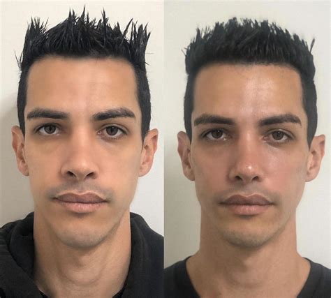 Harmonização Fácial Antes E Depois Masculino
