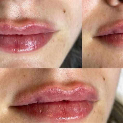 Dr Narin Adem MD | Естетична Дерматология on Instagram: "👄Придаване на ...