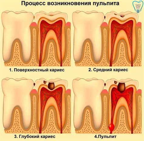 Почему Возникает Пульпит и Как он Лечится? — Клиника Лукашука