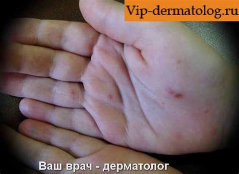 Вирусная пузырчатка фото. Как выглядит вирусная пузырчатка у детей на фото