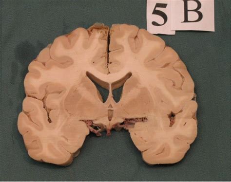 coronal cut  anterior commissure diagram quizlet