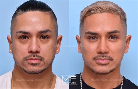 Under Eye Bags & Dark Circles Before and After Pictures Case 1211 | San