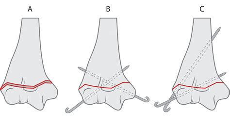 elbow fracture | mybioscience scientific illustrations