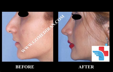 Fleshy Nose and Bony Nose | Bony Nose VS Fat Nose Surgery – GOMED