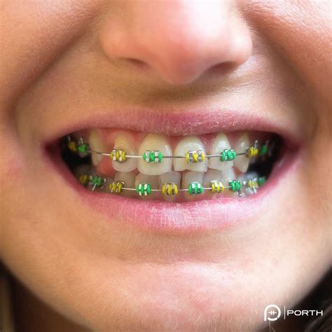 green colored braces   colors   rubber bands