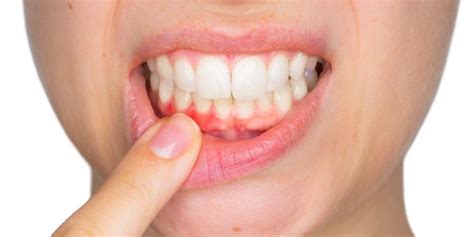 Буйлны үрэвсэлт өвчин (Gum disease or Gingivitis) гэж юу вэ?
