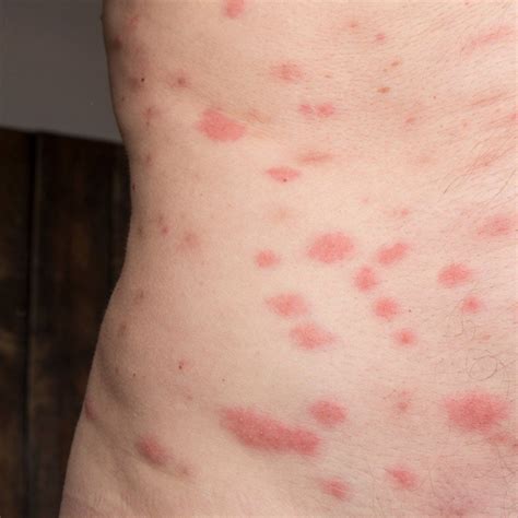 Bed Bug Bites Look Like
