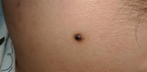 raised mole    rmelanoma