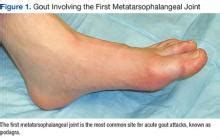 Treatment Options for Acute Gout | Federal Practitioner