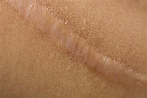 Best Keloid Stock Photos, Pictures & Royalty-Free Images - iStock