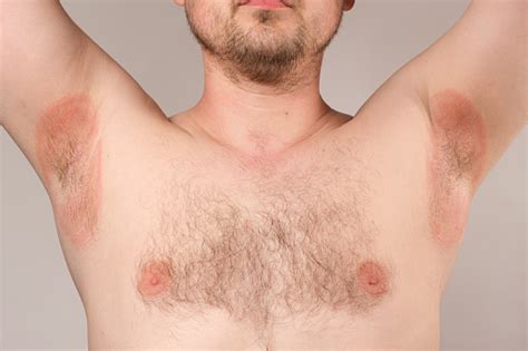 Redness Of The Armpits In A Man Inflammation Or Prickly Heat Red Spots ...