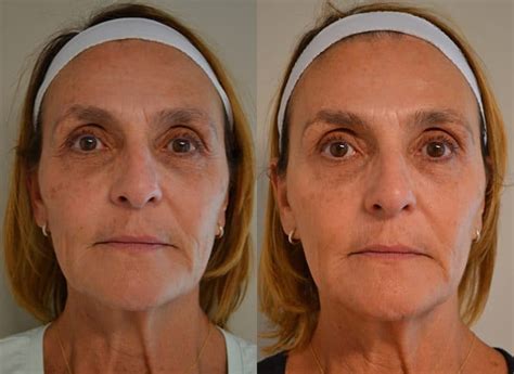 BBL Photofacial Before After Photos - FRESH FACE + EYE